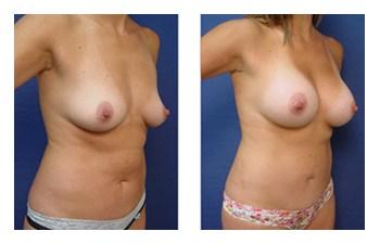 Breast Augmentation — #SS197