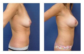 Breast Augmentation — #SS197