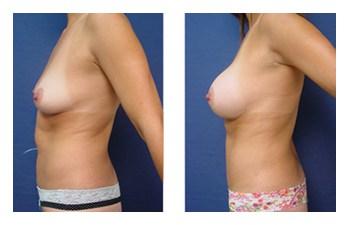 Breast Augmentation — #SS197