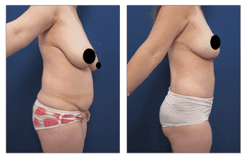 Belly Button Shape - Creating The Best Belly Button For A Tummy Tuck Belly Button Shape - Creating The Best Belly Button For A Tummy Tuck