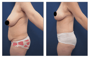 Belly Button Shape Belly Button Shape