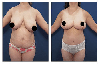 Creating The Best Belly Button For A Tummy Tuck Creating The Best Belly Button For A Tummy Tuck