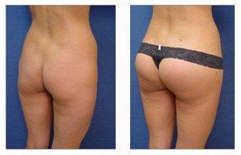 butt implant patient back right view butt implant patient back right view
