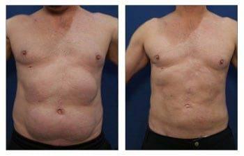 Definitive Treatment of PAH Paradoxical Adipose Hyperplasia Definitive Treatment of PAH Paradoxical Adipose Hyperplasia