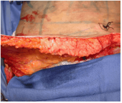 Body Lift Incisions - PAH (Paradoxical Adipose Hyperplasia) Body Lift Incisions - PAH (Paradoxical Adipose Hyperplasia)