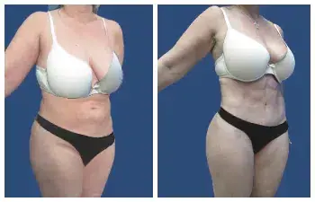 Liposuction Abdoominal Before and After Liposuction Abdoominal Before and After