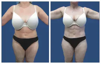 outcome Liposuction Abdominal outcome Liposuction Abdominal