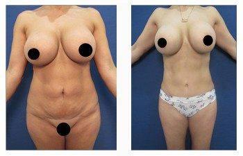 high definition liposuction front view