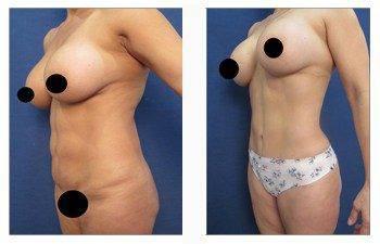 high definition liposuction front left view