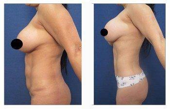 high definition liposuction left view