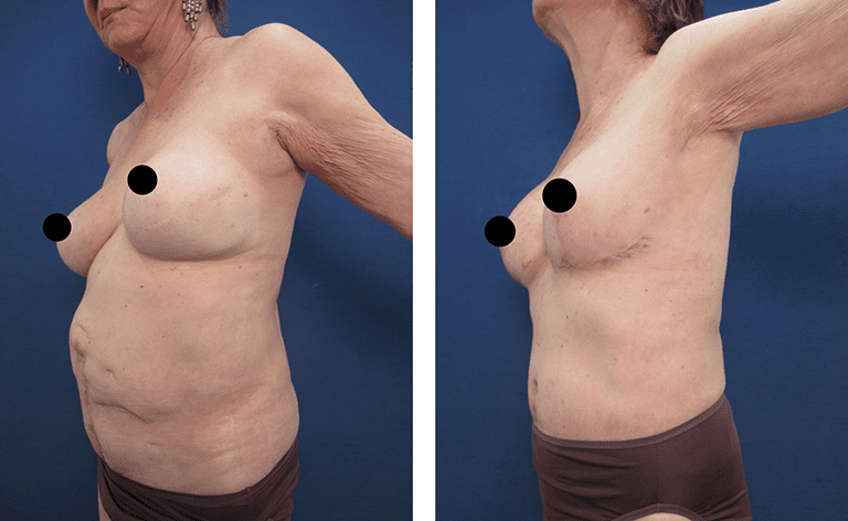 Eliminating A Bulging Belly With A Tummy Tuck Eliminating A Bulging Belly With A Tummy Tuck