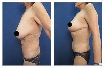 Eliminating Upper Abdominal Skin Rolls with Tummy Tuck Eliminating Upper Abdominal Skin Rolls with Tummy Tuck