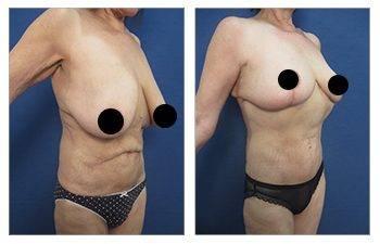 Upper Abdominal Skin Rolls