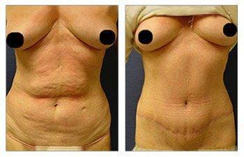 Eliminating Upper Belly Stretch Marks With Tummy Tuck Eliminating Upper Belly Stretch Marks With Tummy Tuck