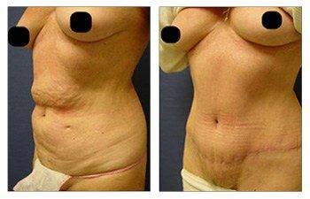 Eliminating Upper Belly Stretch Marks With Tummy Tuck Eliminating Upper Belly Stretch Marks With Tummy Tuck
