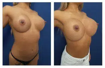 A woman's breasts undergo transformation with Enblock Capsulectomy surgery, revealing remarkable changes before and after the procedure. A woman's breasts undergo transformation with Enblock Capsulectomy surgery, revealing remarkable changes before and after the procedure.