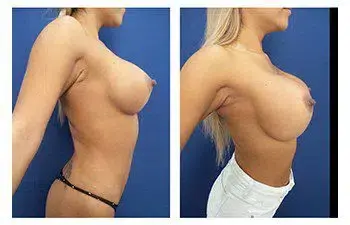 A woman's breasts before and after Enblok Capsulectomy surgery. A woman's breasts before and after Enblok Capsulectomy surgery.