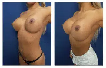 A woman's breasts after undergoing Enblock Capsulectomy surgery. A woman's breasts after undergoing Enblock Capsulectomy surgery.