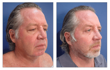 Before and after photos of a man's facelift, showcasing the remarkable transformation.