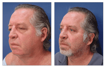 Before and after photos of a man's facial transformation following a successful facelift procedure.