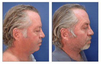Before and after photos showcasing the transformative effects of a man's facelift.