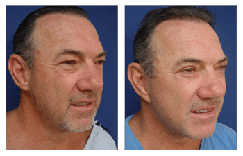 A man's face showing the dramatic transformation after a facelift.