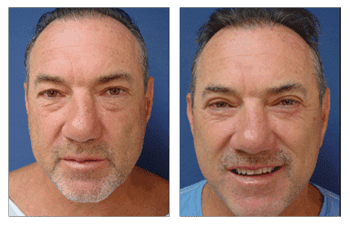 Before and after a man's face undergoing a facelift procedure.