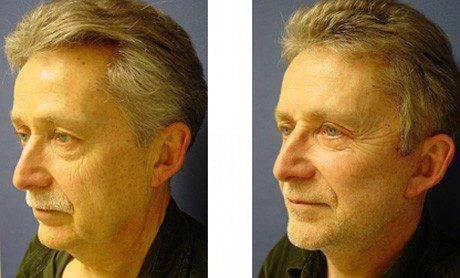 facelift patient 4 front view facelift patient 4 front view
