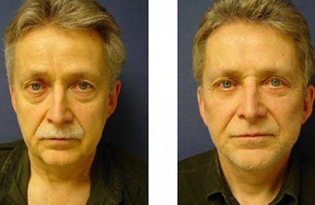 Untitled 2facelift patient 4 front left -Facelift Side Effects Untitled 2facelift patient 4 front left -Facelift Side Effects
