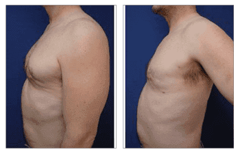 Fat Transfer Following Botched Gynecomastia Fat Transfer Following Botched Gynecomastia