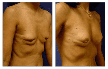 Breast augmentation before and after with Fat Transfer Following Implant Removal. Breast augmentation before and after with Fat Transfer Following Implant Removal.