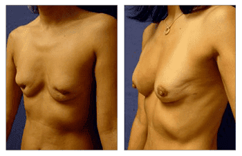 Implant Removal Surgery Los Angeles Implant Removal Surgery Los Angeles