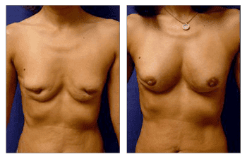 Fat Transfer Following Implant Removal Fat Transfer Following Implant Removal