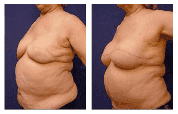 Fat Transfer Following Breast Reconstruction Fat Transfer Following Breast Reconstruction
