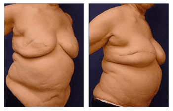 Breast enhancement Los Angeles Breast enhancement Los Angeles