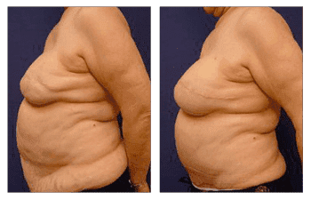 Breast lift Laguna Beach Breast lift Laguna Beach