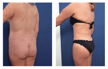 A woman in a bikini before and after **liposuction**.