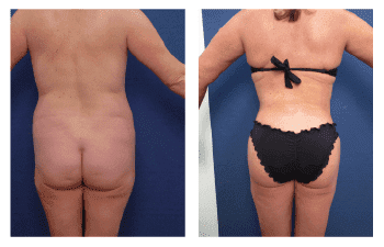 Fat Transfer For Buttocks Augmentation