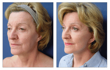 A woman's face before and after a facelift, featuring the transformative effects of a fat transfer.