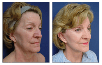 A woman's face undergoes a transformation with the help of a facelift, featuring an alternative option of fat transfer.