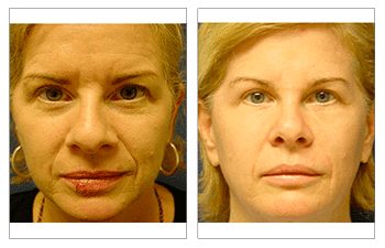 Fat Transfer for Female Faces Fat Transfer for Female Faces