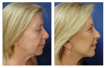 A woman's face before and after fat transfer.