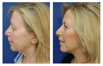 A woman's face transformed after rhinoplasty utilizing fat transfer for a refined appearance.