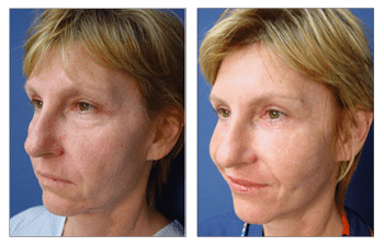 Blepharoplasty women patient Blepharoplasty women patient
