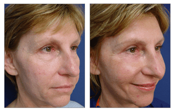 A woman's face before and after a facelift, showcasing remarkable transformations through Fat Transfer and Lower Blepharoplasty. A woman's face before and after a facelift, showcasing remarkable transformations through Fat Transfer and Lower Blepharoplasty.