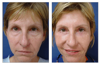 Blepharoplasty surgery Blepharoplasty surgery