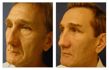 Fat Transfer Male Faces Fat Transfer Male Faces