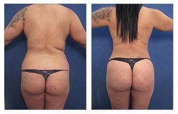 How Does Your BBL Shape Change With Aging? How Does Your BBL Shape Change With Aging?