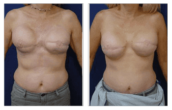 A woman's breast before and after Fat Transfer surgery. A woman's breast before and after Fat Transfer surgery.