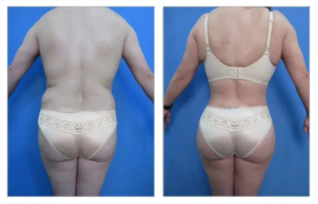 A woman wearing underwear and a BBL shape and size garment. A woman wearing underwear and a BBL shape and size garment.
